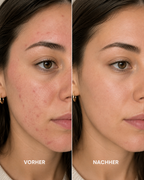 Acne Spot Care