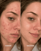 Acne Care Collection Box